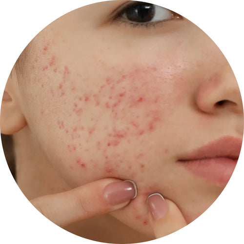 Skin Care Oil for Acne and Blemishes