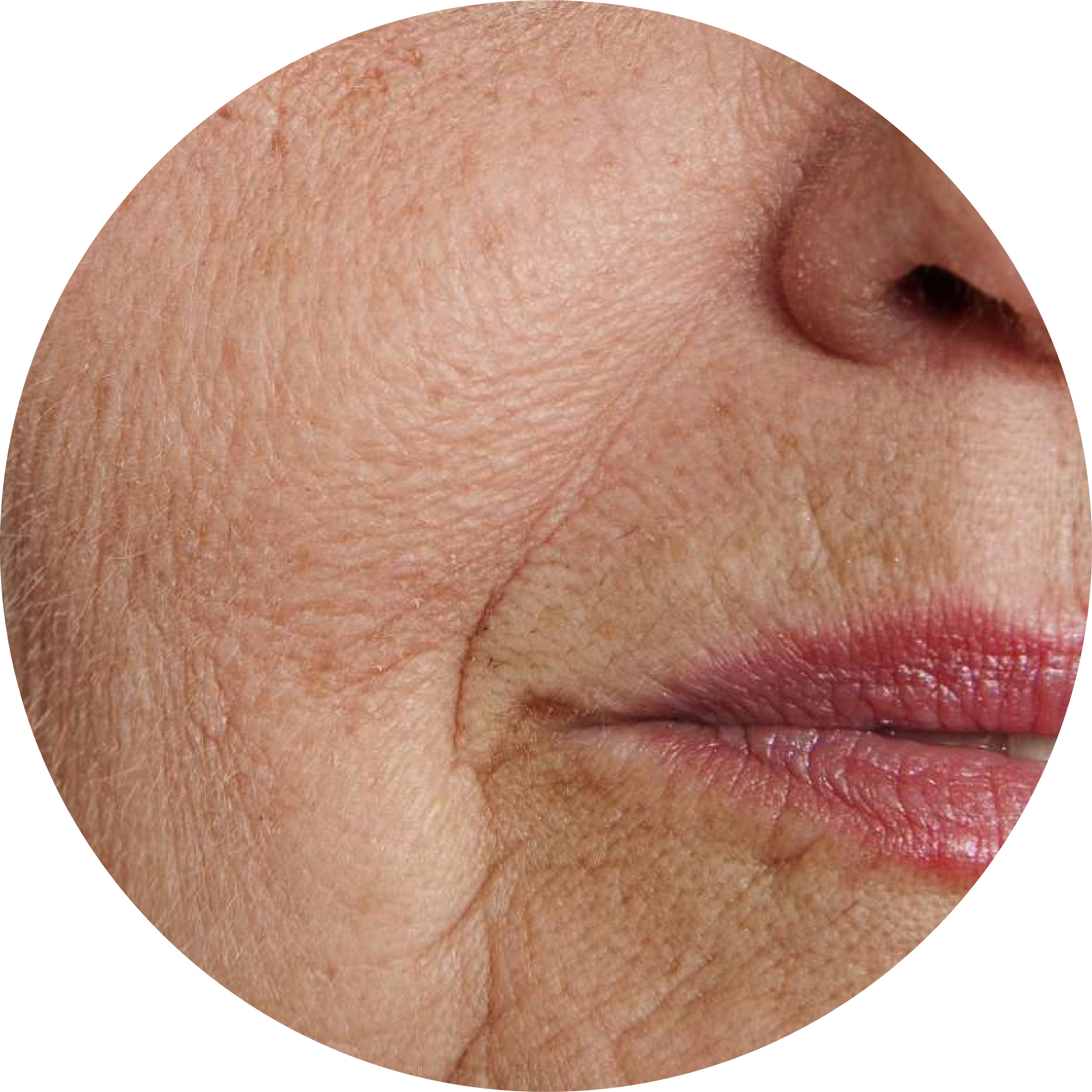Aging Skin and Wrinkles