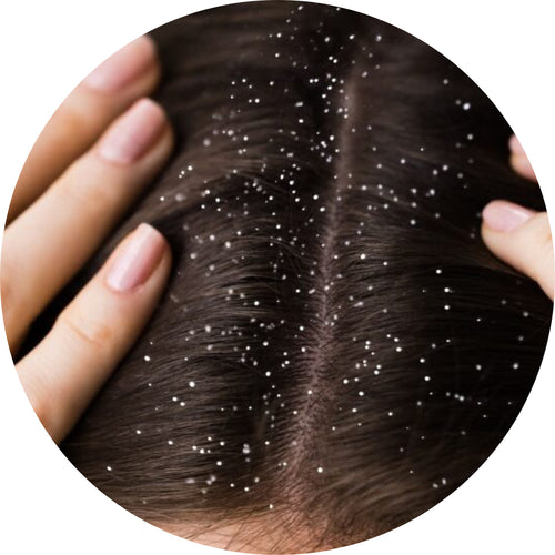 Herbal Hair Oil for Dandruff