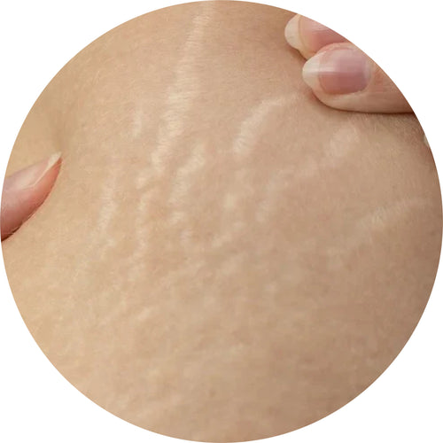 Skin Care Oil for Stretch Marks